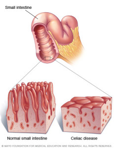 celiac disease